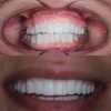 Geçici Diş Reçinesi - 3d geçici diş reçinesi - Görsel 5