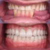 Geçici Diş Reçinesi - 3d geçici diş reçinesi - Görsel 3