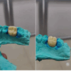 Daimi kalıcı Diş Reçinesi-3d yazıcı kalıcı kron - Görsel 2