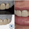 Daimi kalıcı Diş Reçinesi-3d yazıcı kalıcı kron - Görsel 7
