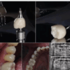 Daimi kalıcı Diş Reçinesi-3d yazıcı kalıcı kron - Görsel 10